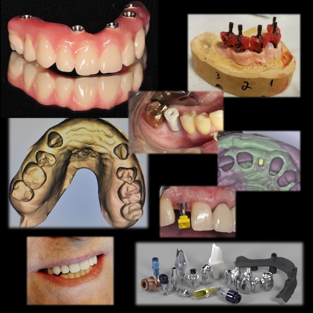 The Ultimate Implant Training for The General Dentist Spring 2025 Prosthetic Module 2400 + HST